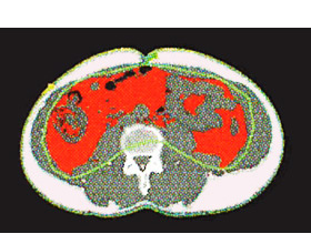 内臓肥満ドックのCT検査内臓脂肪のイメージ図